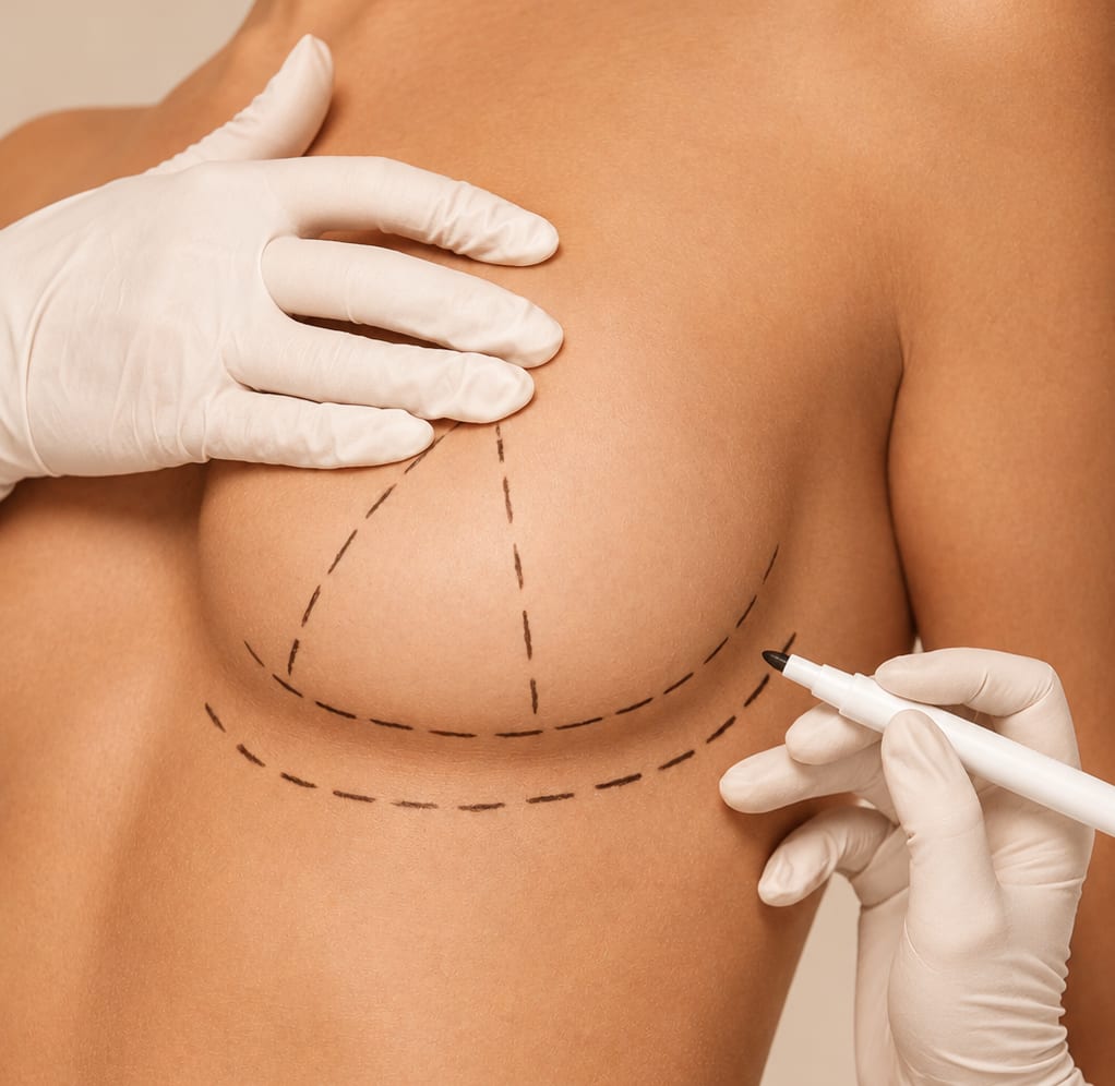 Surgical markings drawn on a breast before surgery